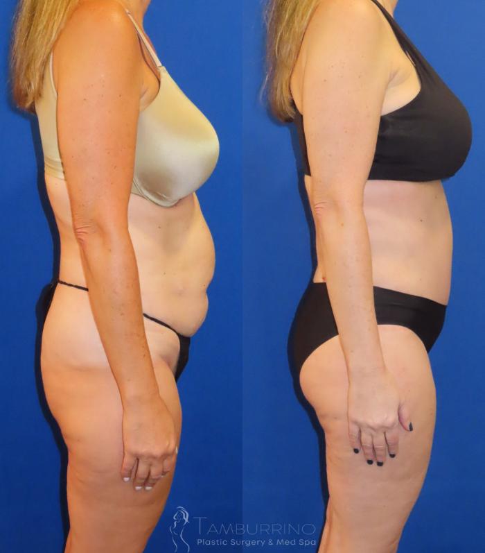 Before & After Tummy Tuck Case 60 Right Side View in Doylestown, PA