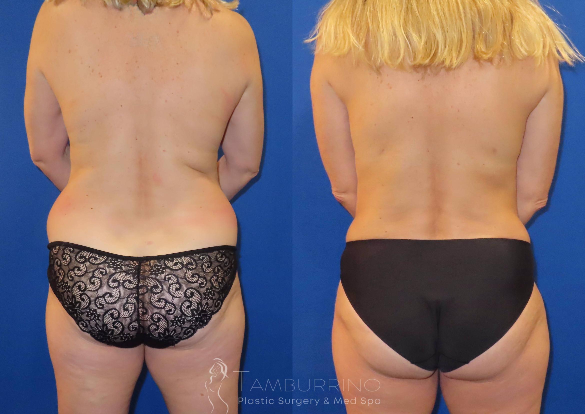 Before & After Tummy Tuck Case 63 Back View in Doylestown, PA