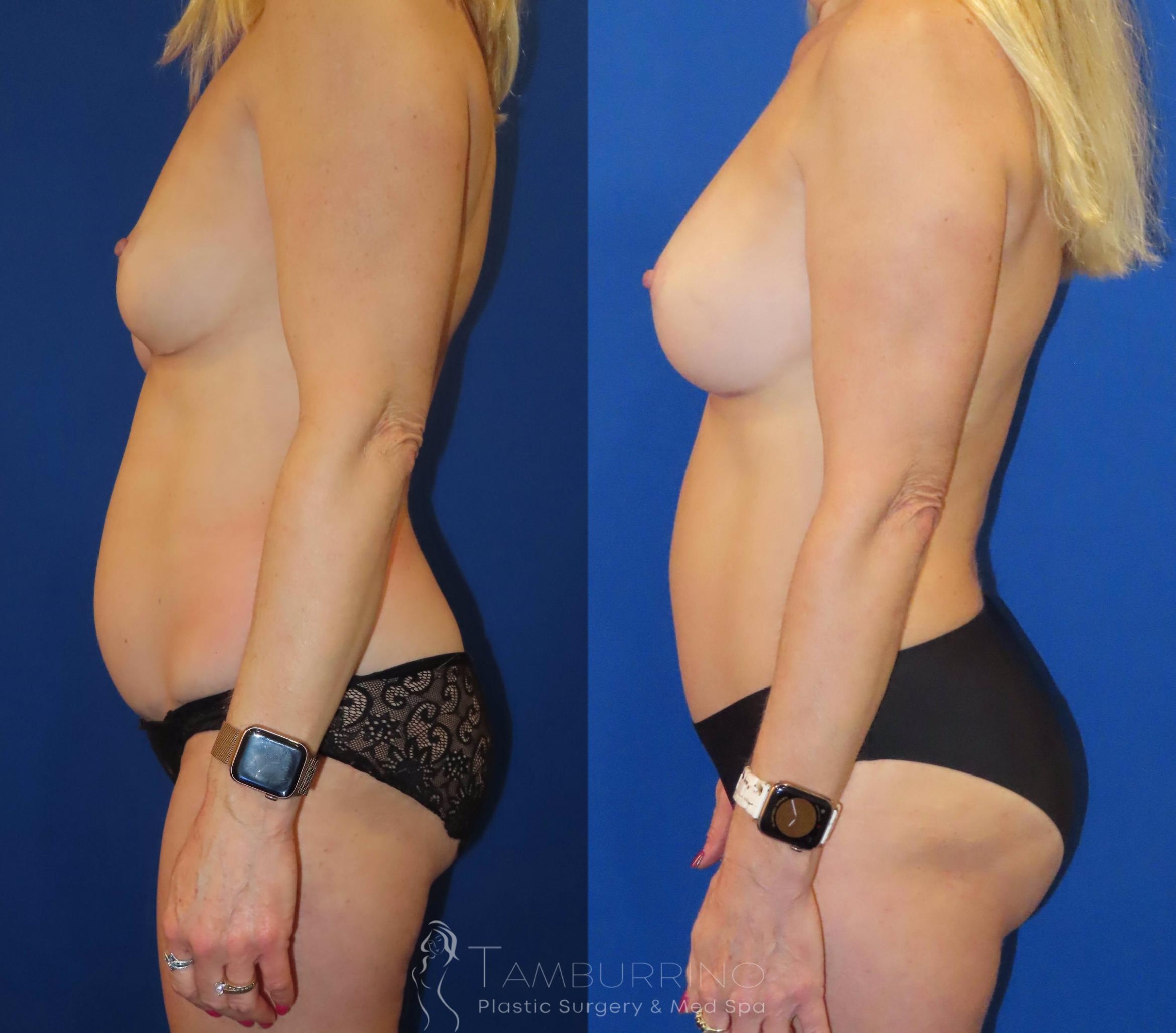 Before & After Tummy Tuck Case 63 Left Side View in Doylestown, PA