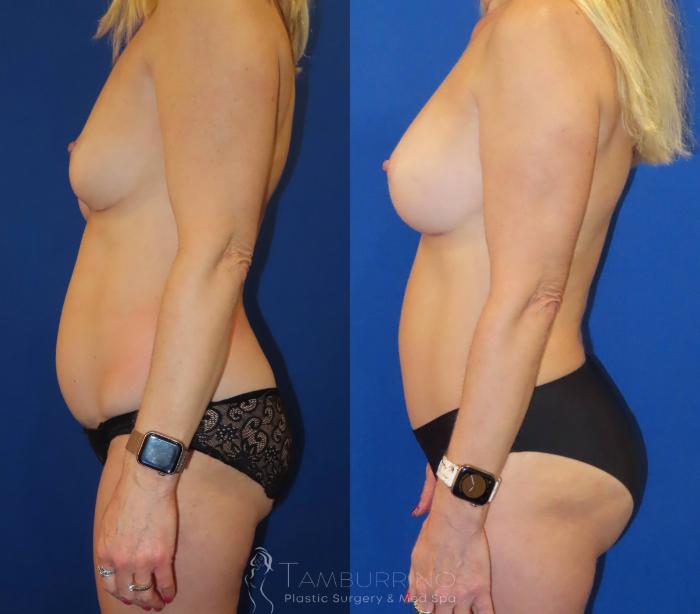 Before & After Tummy Tuck Case 63 Left Side View in Doylestown, PA