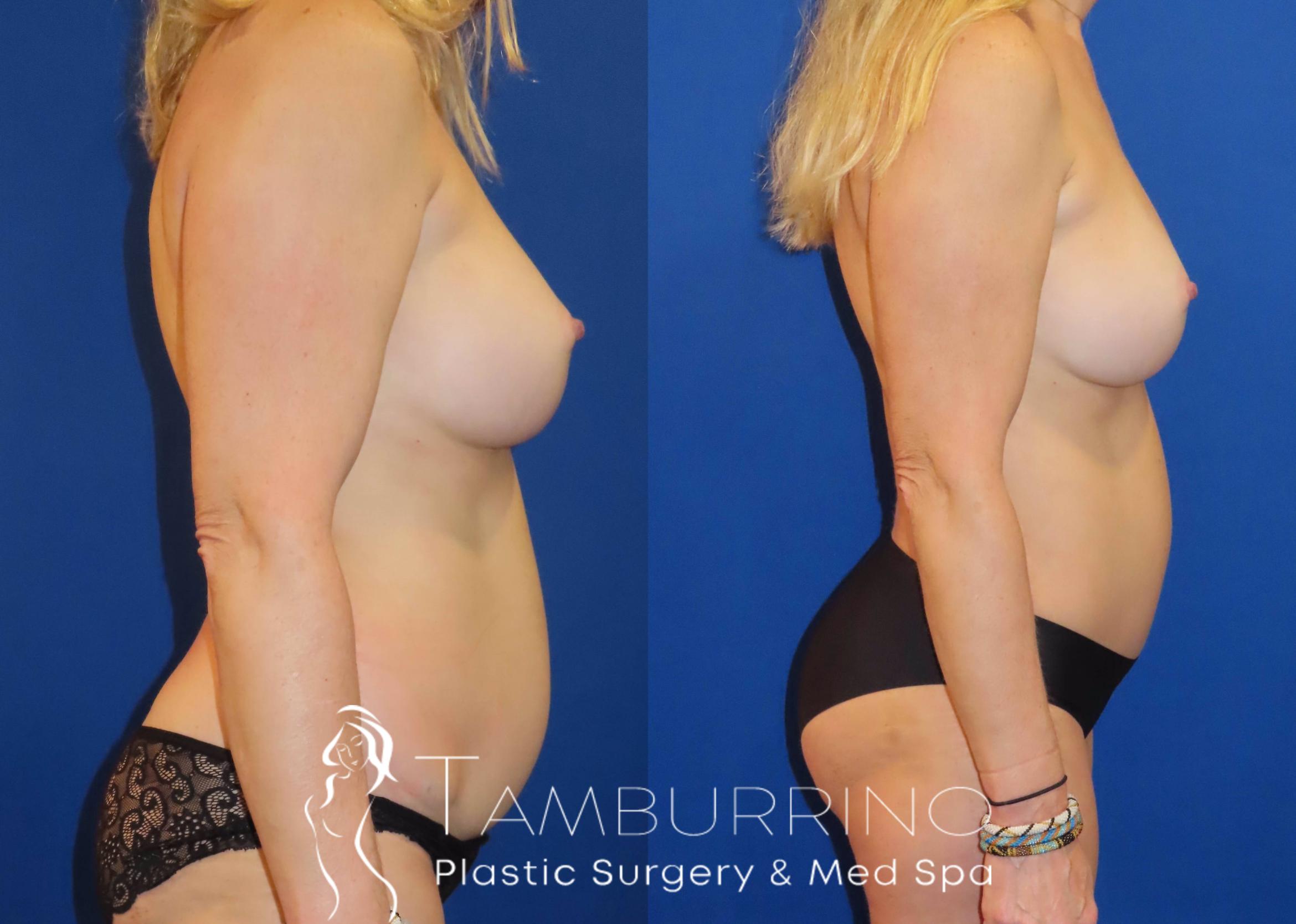 Before & After Tummy Tuck Case 63 Right Side View in Doylestown, PA