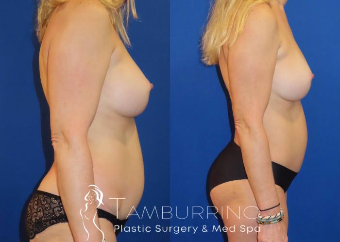 Before & After Tummy Tuck Case 63 Right Side View in Doylestown, PA
