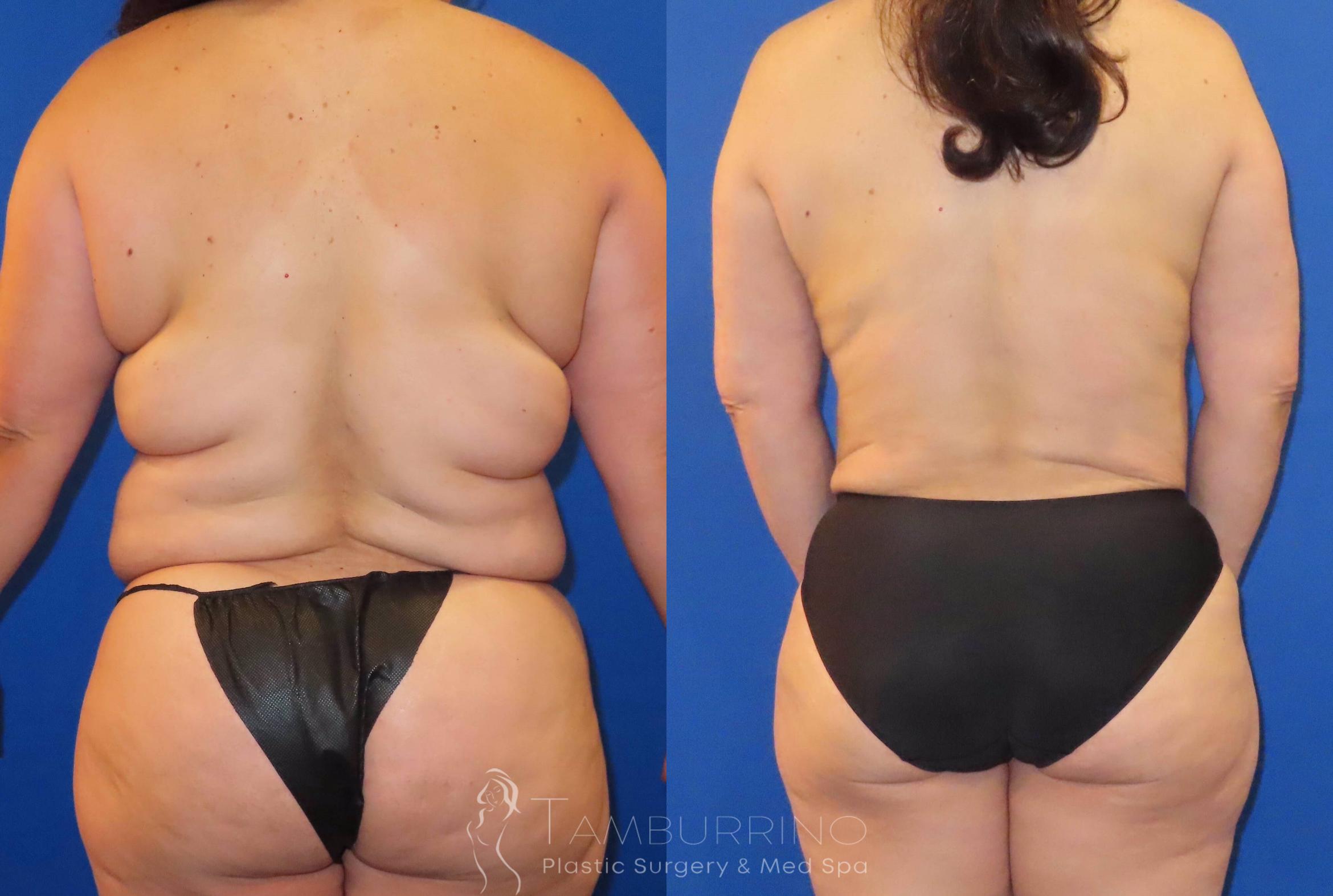 Before & After Tummy Tuck Case 64 Back View in Doylestown, PA