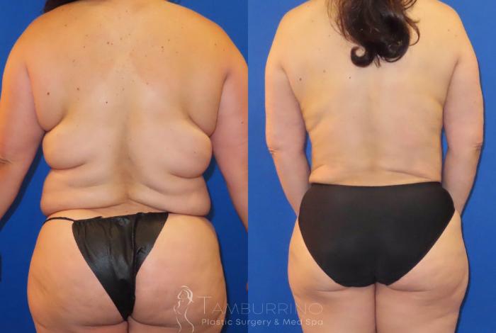 Before & After Tummy Tuck Case 64 Back View in Doylestown, PA
