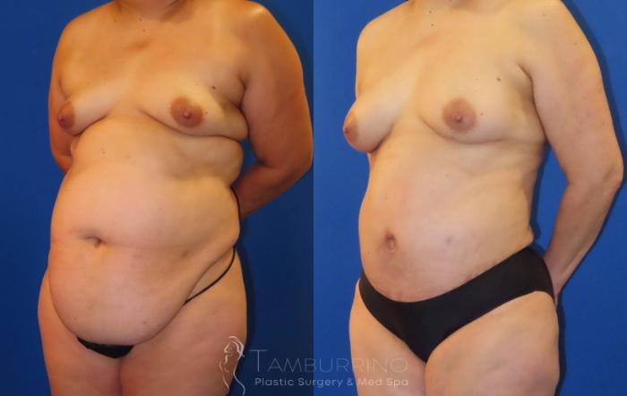 Before & After Tummy Tuck Case 64 Left Oblique View in Doylestown, PA