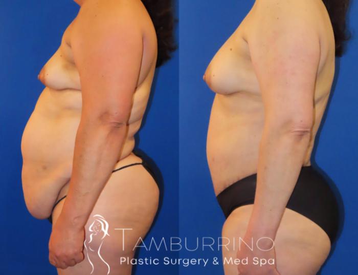 Before & After Tummy Tuck Case 64 Left Side View in Doylestown, PA