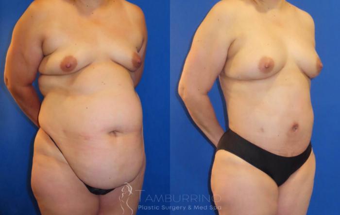 Before & After Tummy Tuck Case 64 Right Oblique View in Doylestown, PA