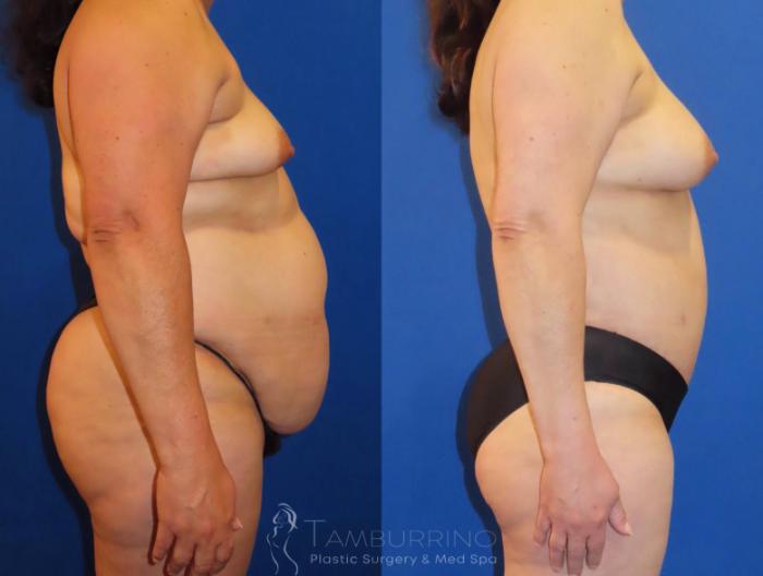 Before & After Tummy Tuck Case 64 Right Side View in Doylestown, PA