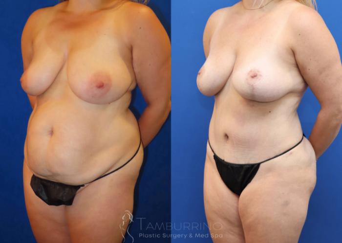 Before & After Tummy Tuck Case 67 Left Oblique View in Doylestown, PA