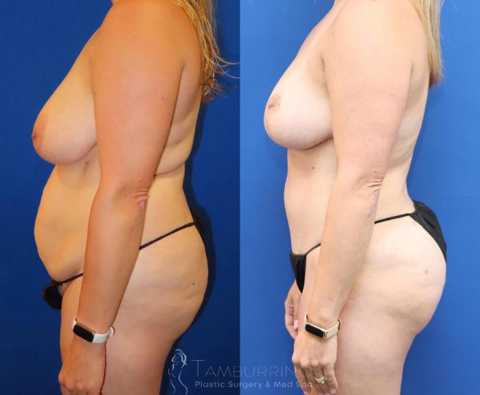 Before & After Tummy Tuck Case 67 Left Side View in Doylestown, PA