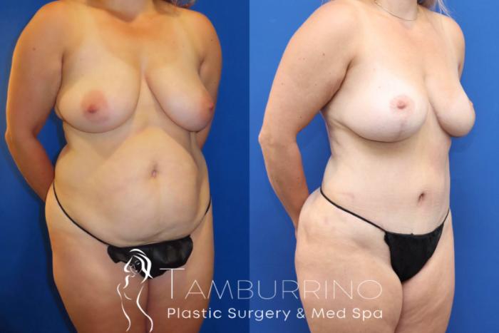 Before & After Tummy Tuck Case 67 Right Oblique View in Doylestown, PA