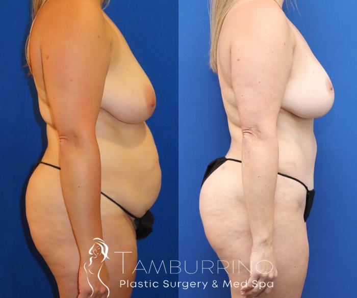 Before & After Tummy Tuck Case 67 Right Side View in Doylestown, PA