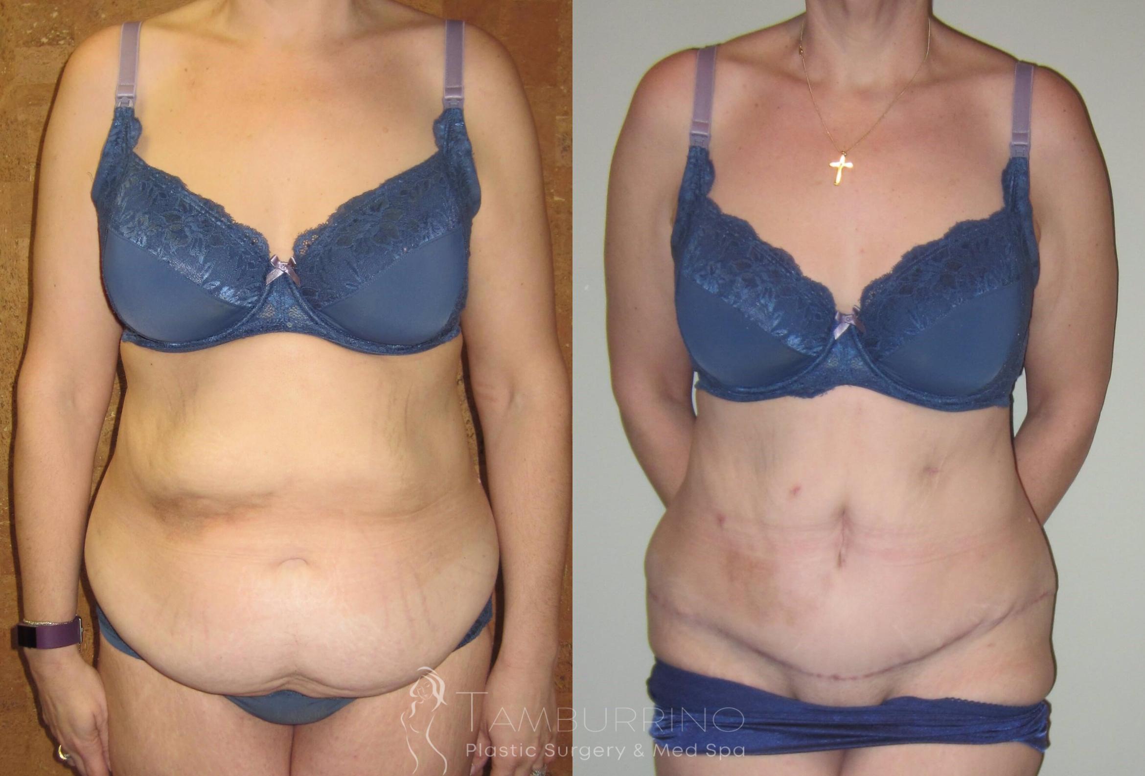 Before & After Tummy Tuck Case 7 Frontal View in Doylestown, PA
