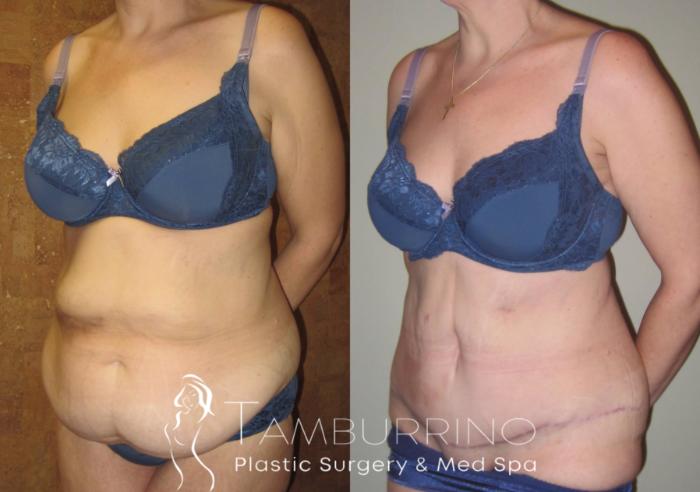 Before & After Tummy Tuck Case 7 Oblique View in Doylestown, PA