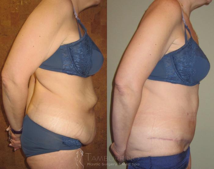 Before & After Tummy Tuck Case 7 Side View in Doylestown, PA