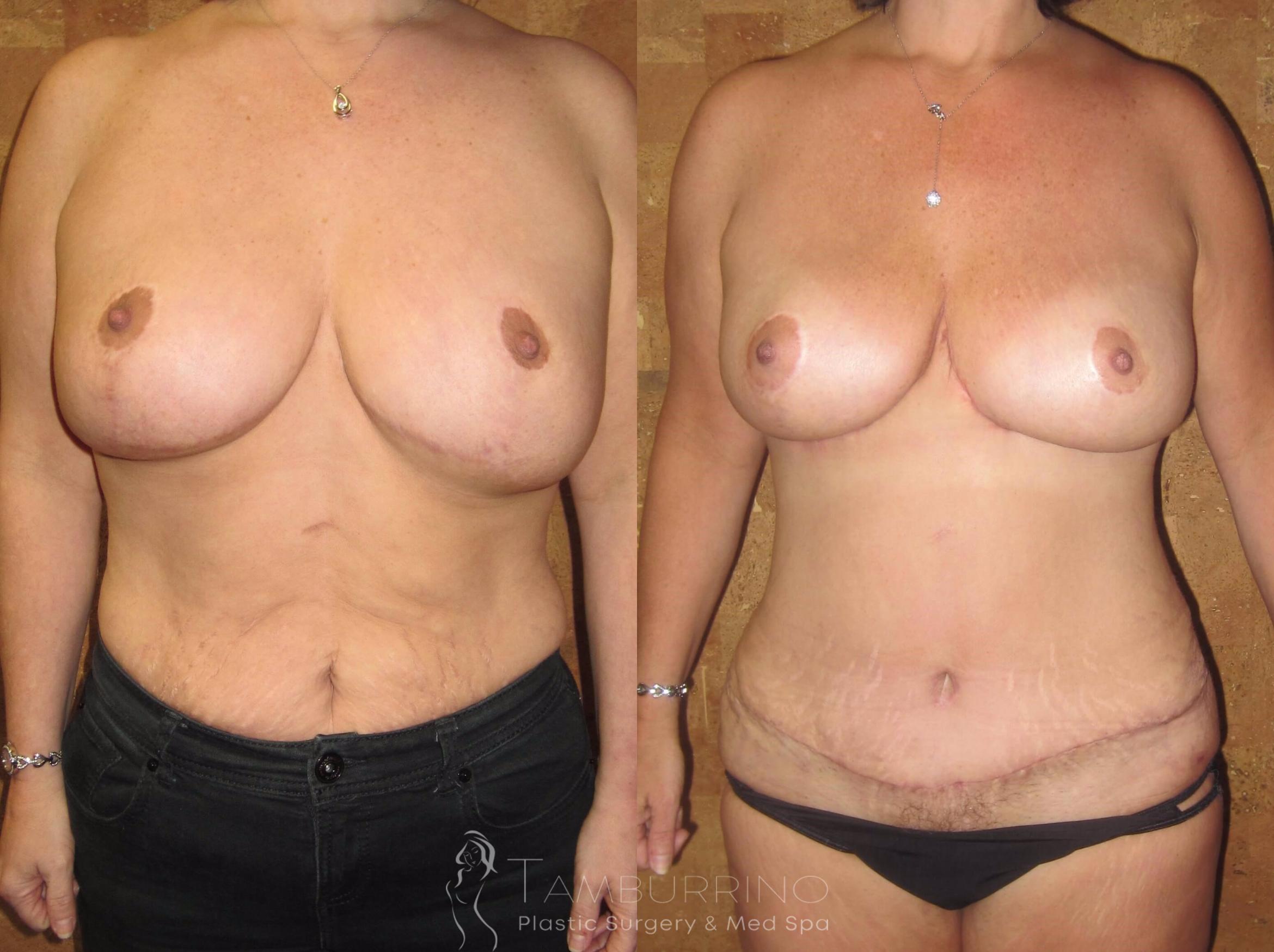 Before & After Tummy Tuck Case 8 Frontal View in Doylestown, PA