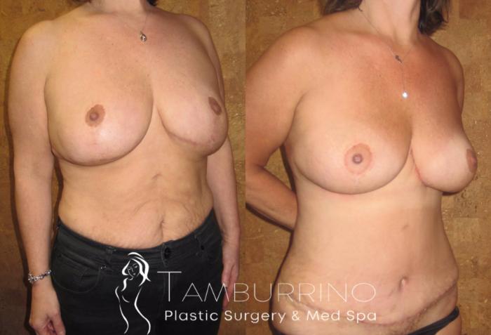 Before & After Tummy Tuck Case 8 Oblique View in Doylestown, PA