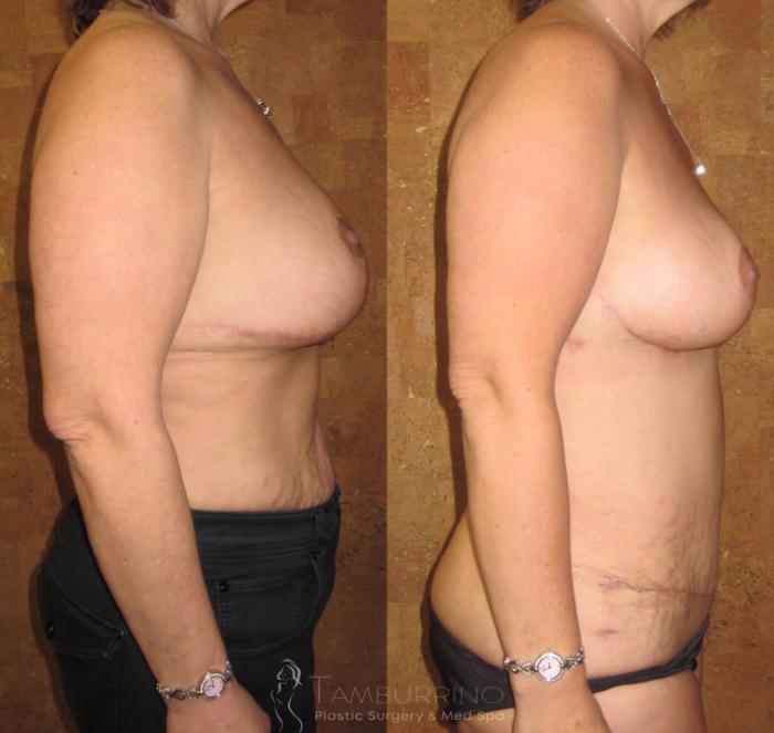 Before & After Tummy Tuck Case 8 Side View in Doylestown, PA