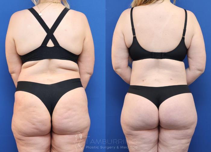 Before & After Tummy Tuck Case 81 Back View in Doylestown, PA