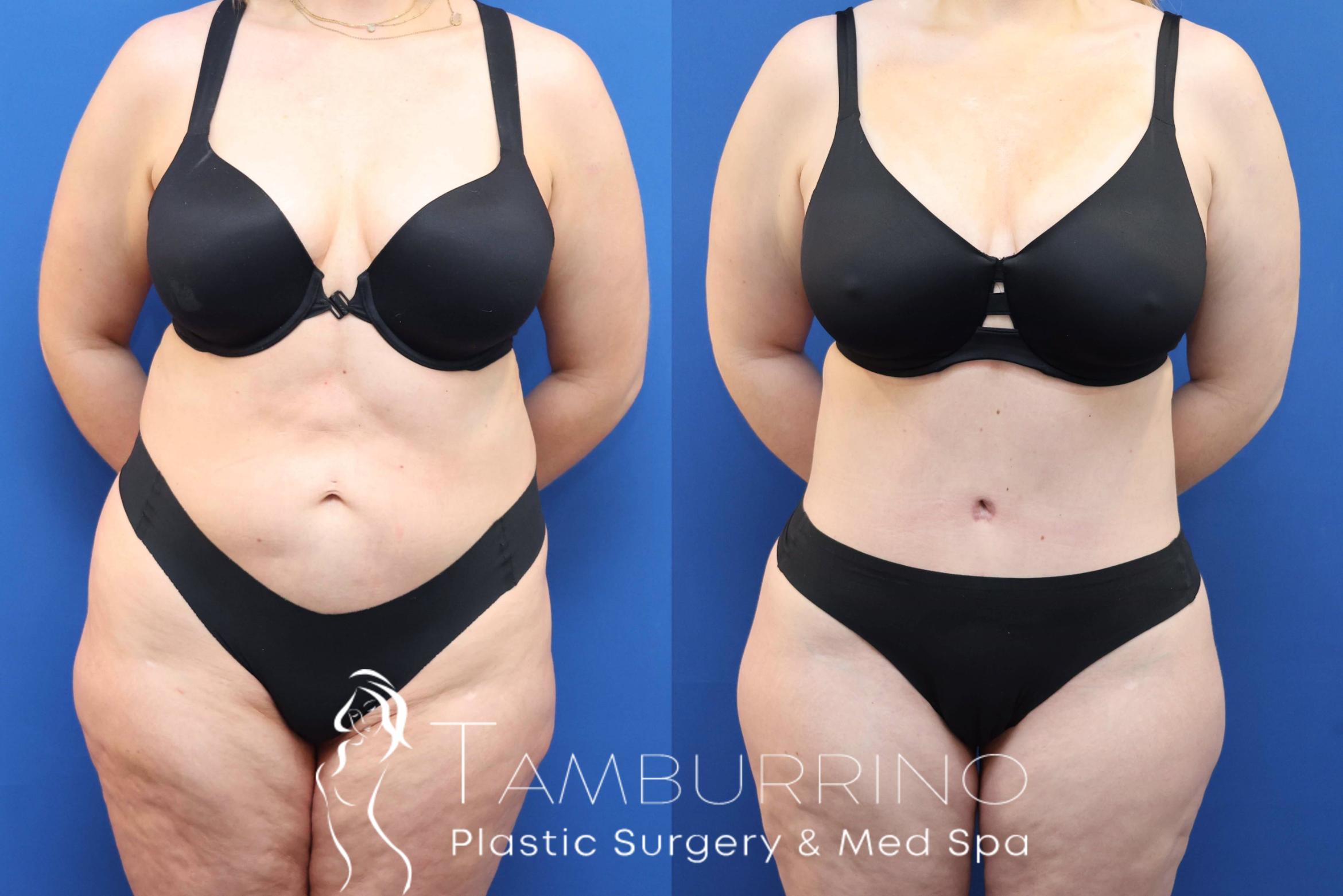 Before & After Tummy Tuck Case 81 Front View in Doylestown, PA