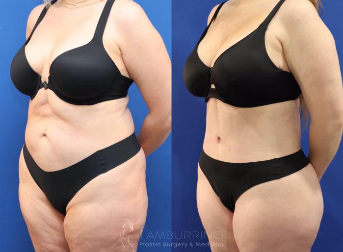 Before & After Tummy Tuck Case 81 Left Oblique View in Doylestown, PA