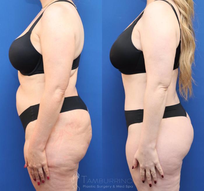 Before & After Tummy Tuck Case 81 Left Side View in Doylestown, PA