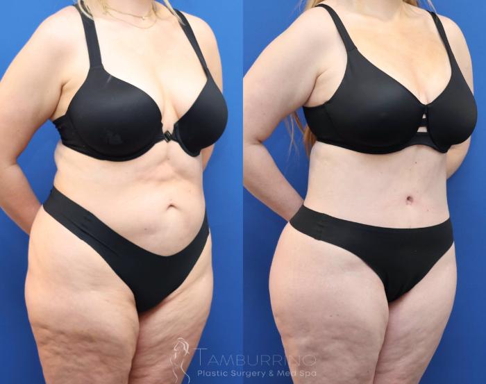 Before & After Tummy Tuck Case 81 Right Oblique View in Doylestown, PA