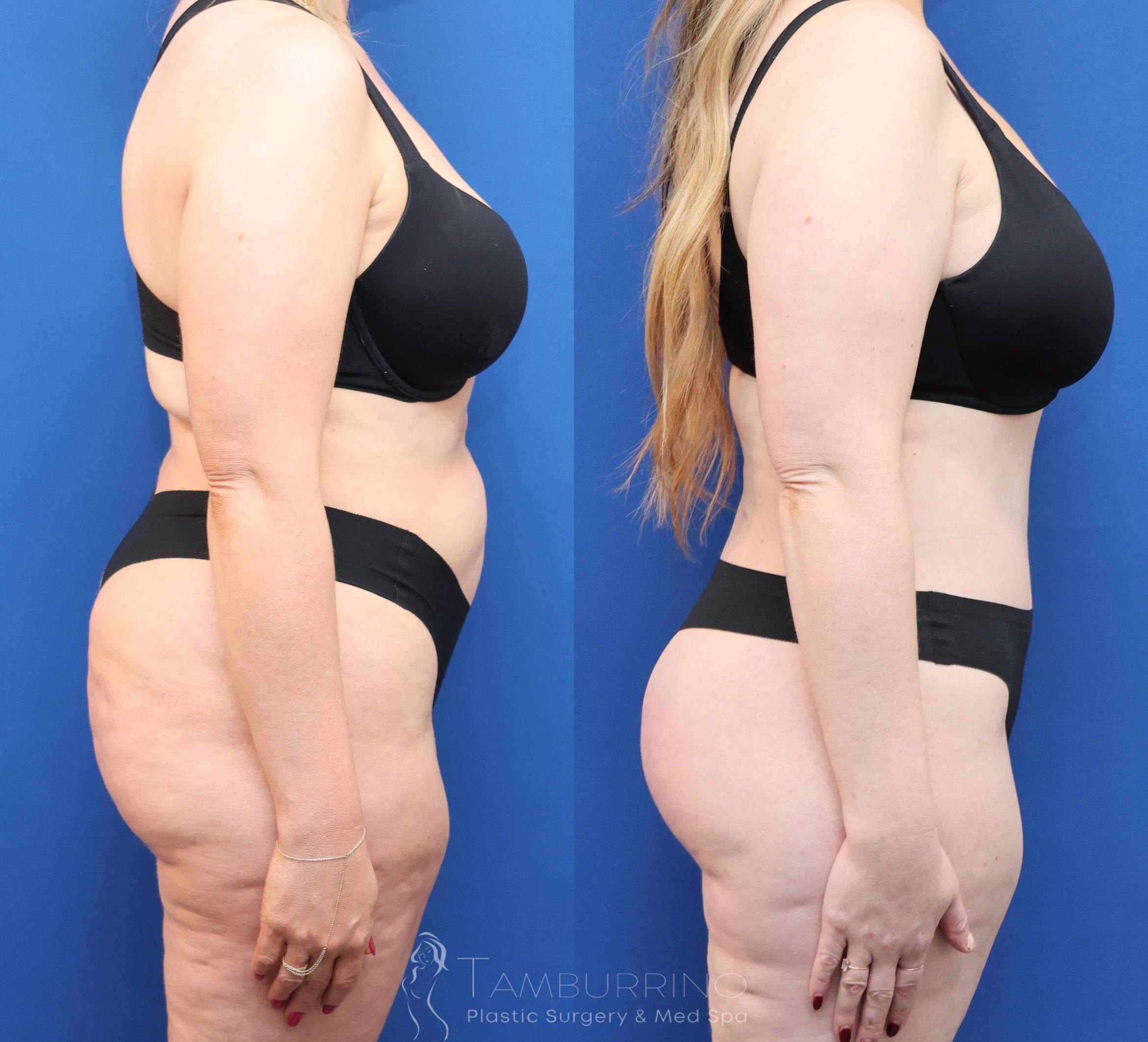 Before & After Tummy Tuck Case 81 Right Side View in Doylestown, PA