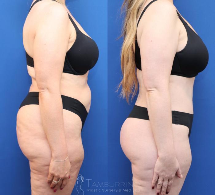 Before & After Tummy Tuck Case 81 Right Side View in Doylestown, PA