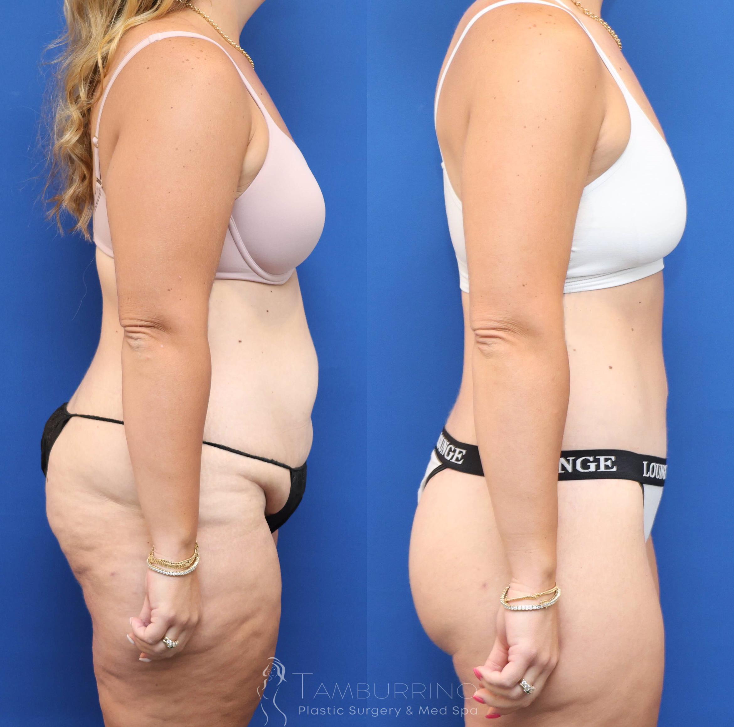 Before & After Lower Body Lift Case 83 Right Side View in Doylestown, PA