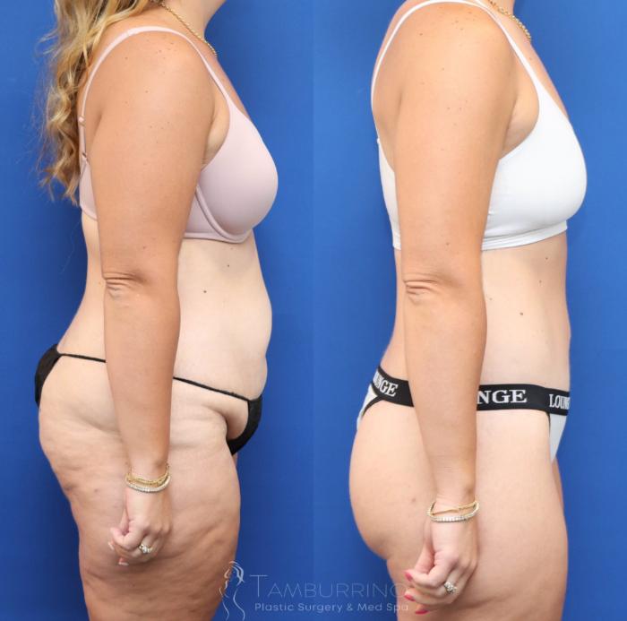 Before & After Lower Body Lift Case 83 Right Side View in Doylestown, PA