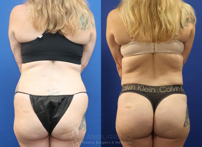 Before & After Liposuction Case 86 Back View in Doylestown, PA