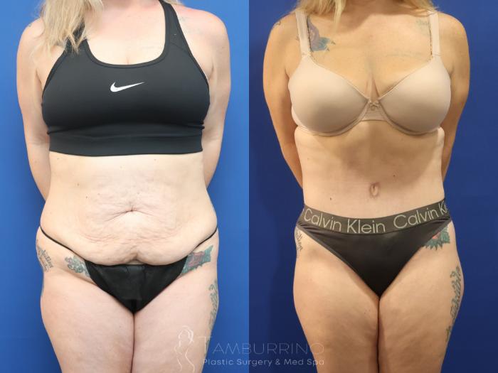 Before & After Liposuction Case 86 Front View in Doylestown, PA