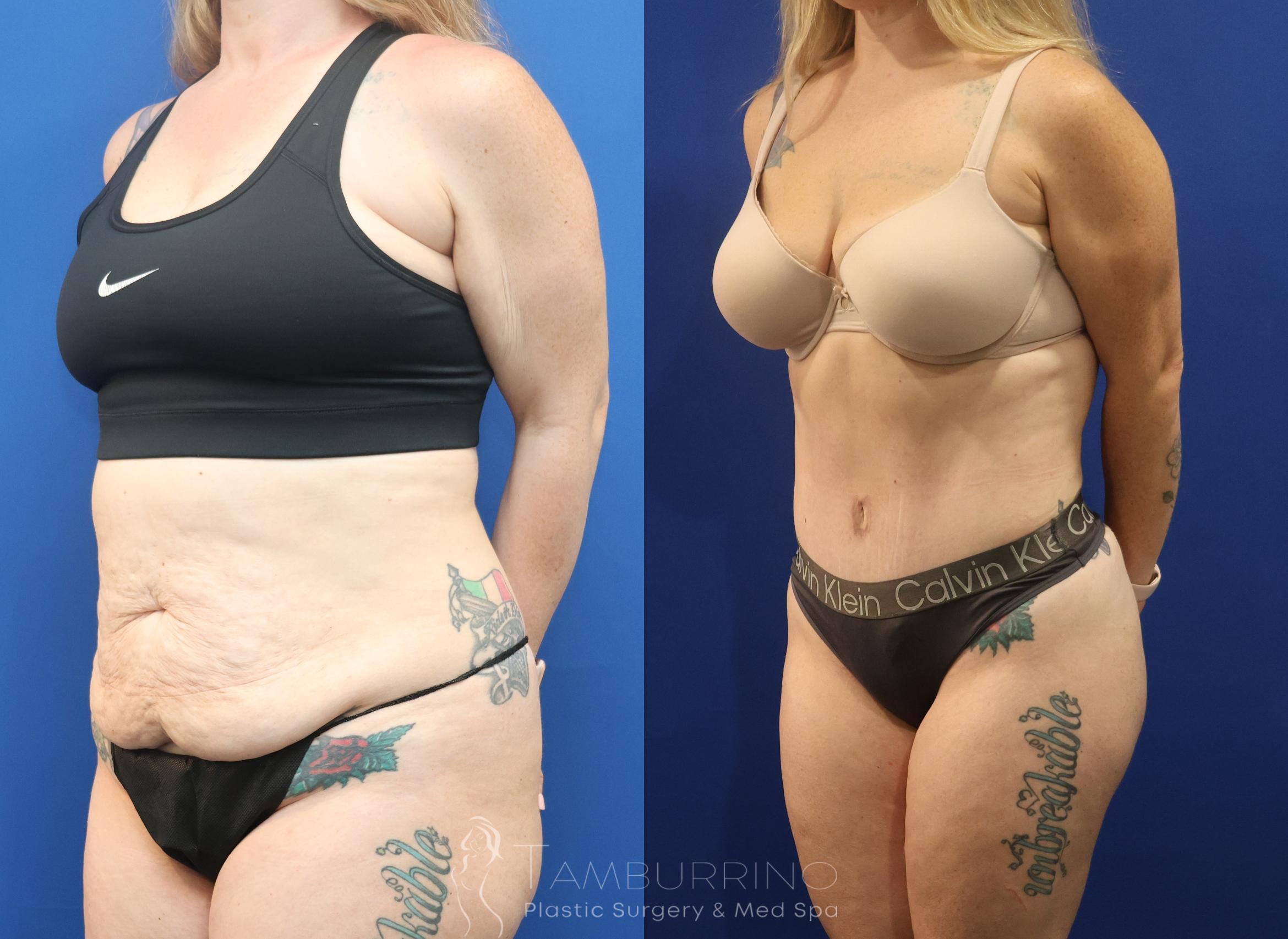 Before & After Liposuction Case 86 Left Oblique View in Doylestown, PA