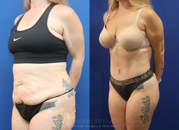 Before & After Liposuction Case 86 Left Oblique View in Doylestown, PA