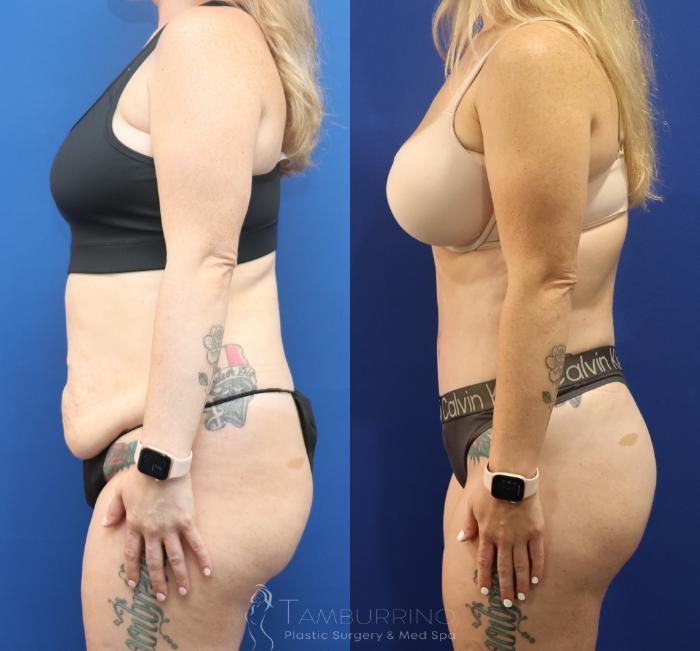 Before & After Liposuction Case 86 Left Side View in Doylestown, PA