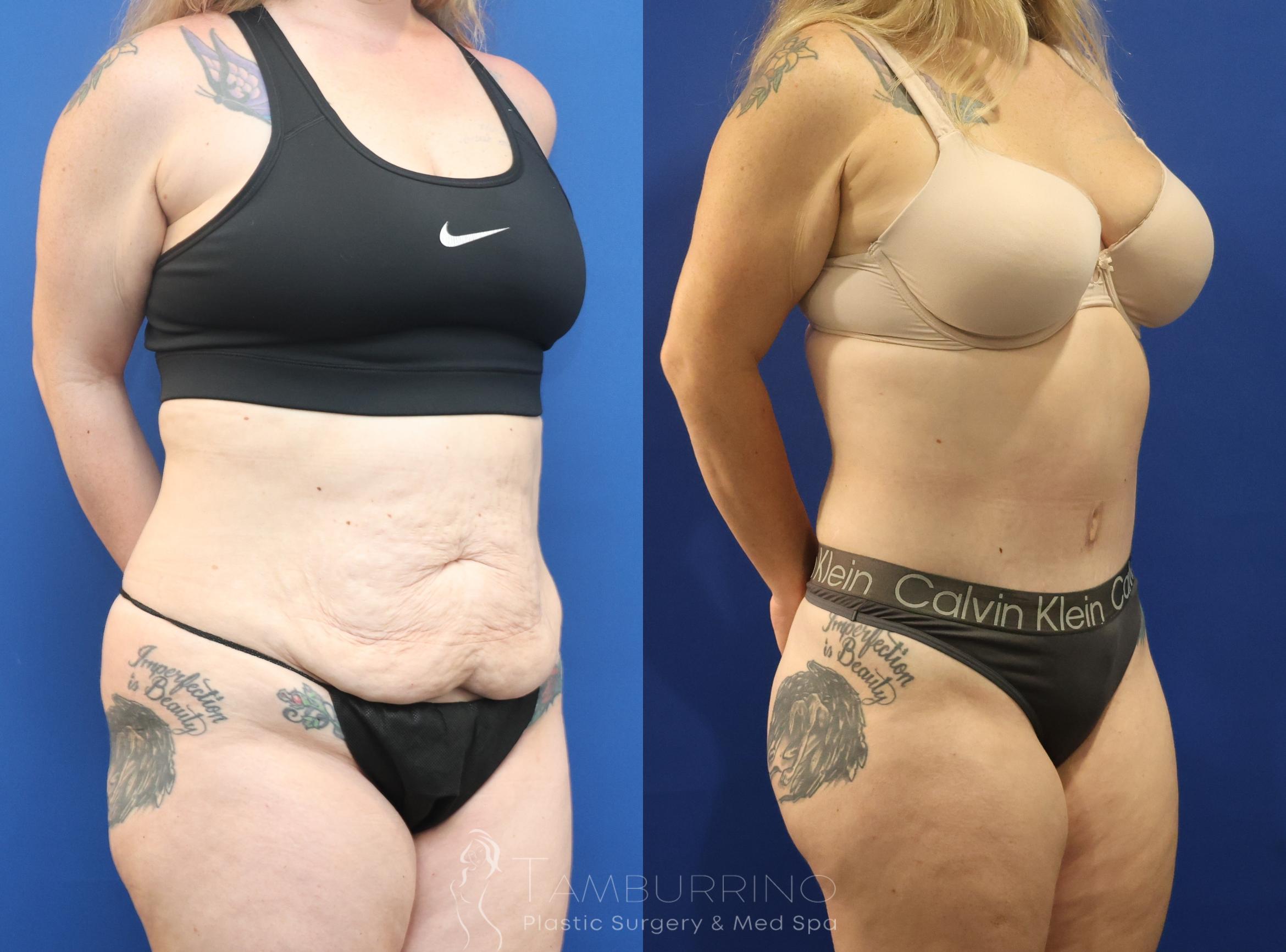 Before & After Liposuction Case 86 Right Oblique View in Doylestown, PA