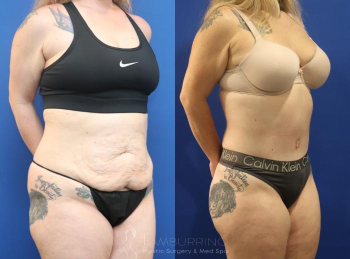 Before & After Liposuction Case 86 Right Oblique View in Doylestown, PA