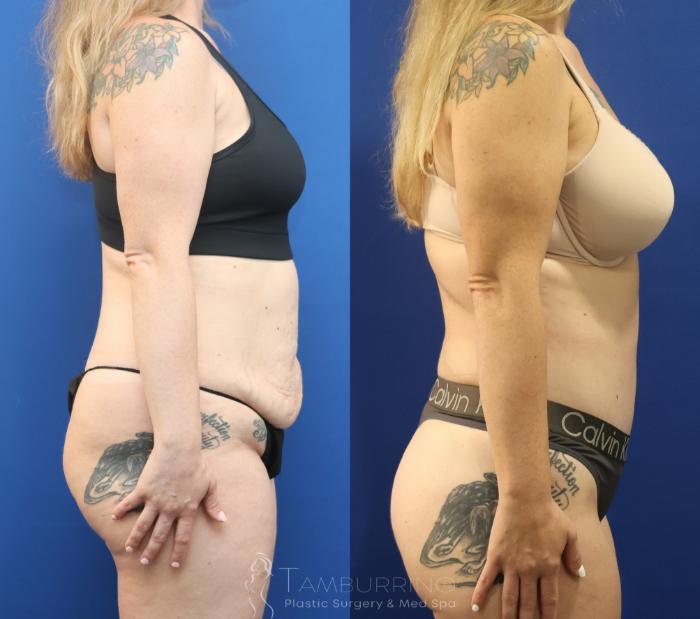 Before & After Liposuction Case 86 Right Side View in Doylestown, PA