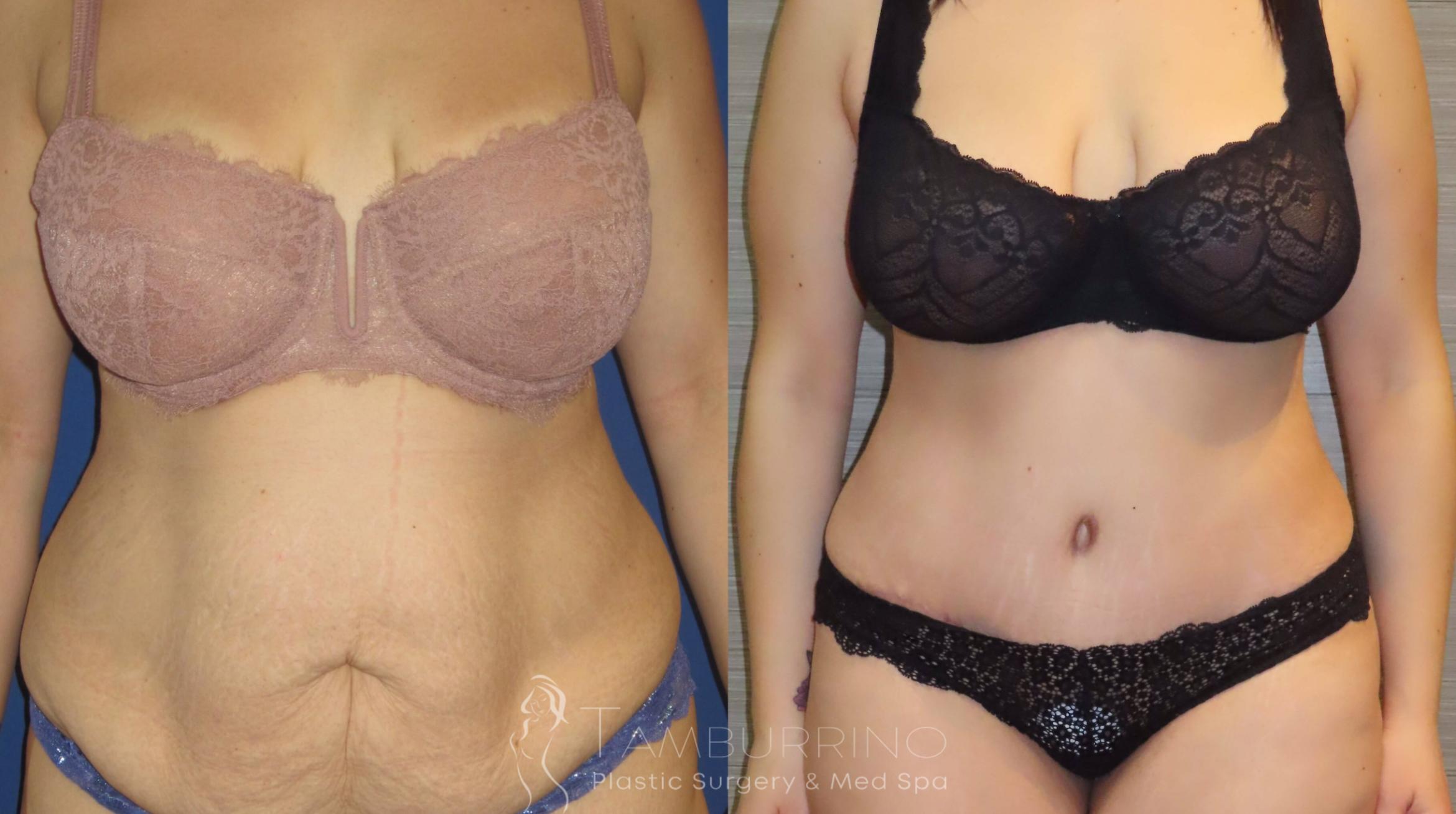 Before & After Tummy Tuck Case 9 Frontal View in Doylestown, PA