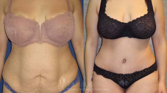 Before & After Tummy Tuck Case 9 Frontal View in Doylestown, PA