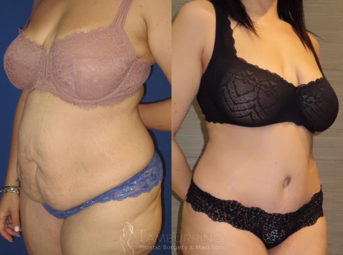 Before & After Tummy Tuck Case 9 Oblique View in Doylestown, PA