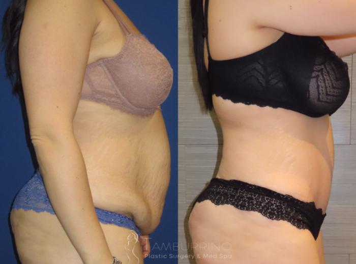 Before & After Tummy Tuck Case 9 Side #1 View in Doylestown, PA