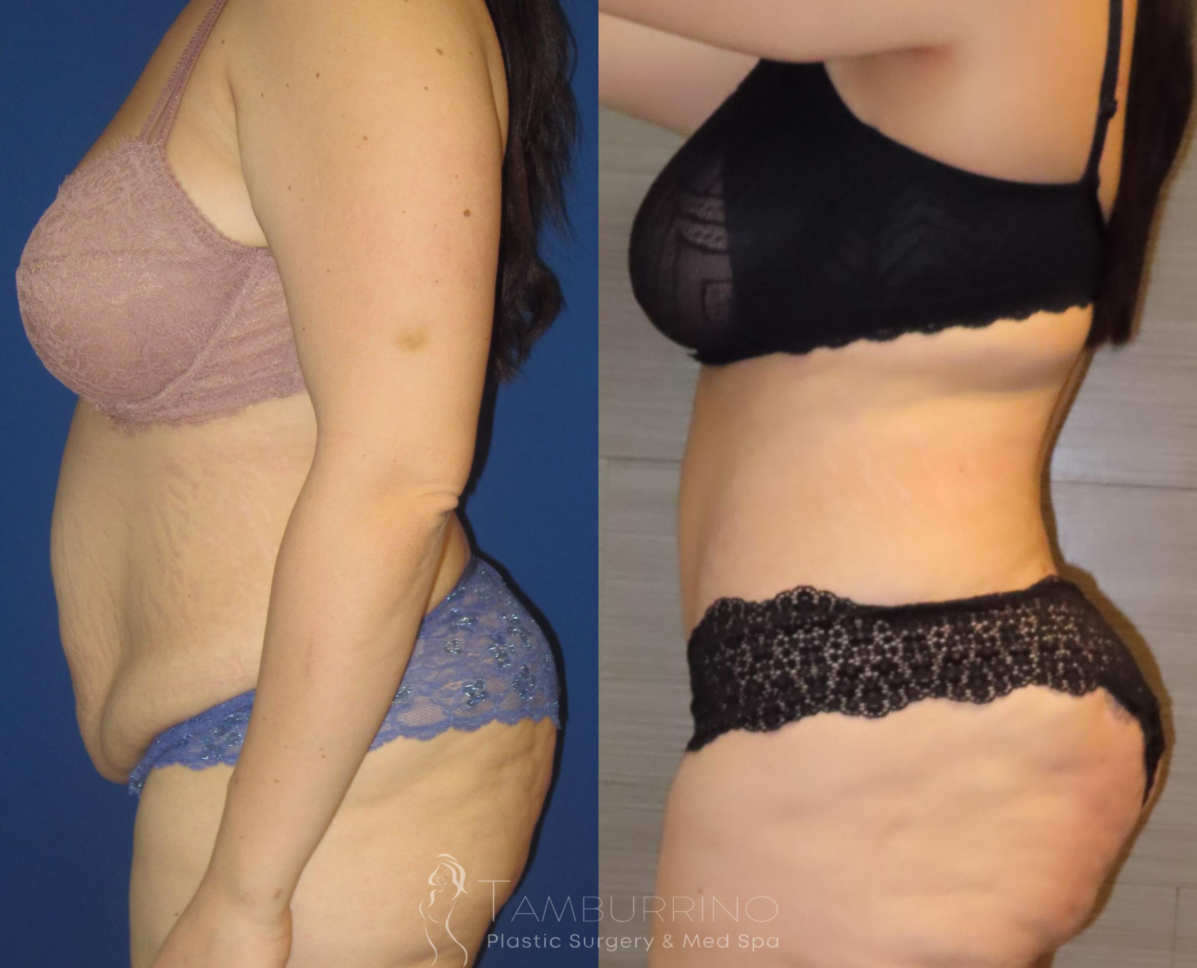 Before & After Tummy Tuck Case 9 Side #2 View in Doylestown, PA