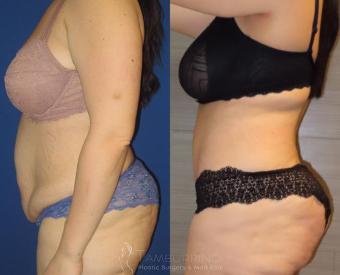 Before & After Tummy Tuck Case 9 Side #2 View in Doylestown, PA